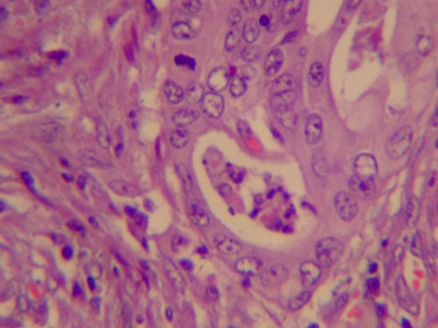 Figura 8. Detalle de carcinoma invasor. Se observa diferenciacin glandular, con clulas de ncleos vesiculosos y algunas clulas necrticas intraluminales. Numerosas clulas fibroblsticas circundantes.